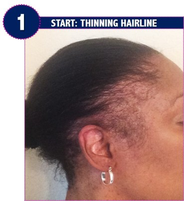 thinning edges, before, application, natrual, thinning hairline, hair loss, traction alopecia, amid beauty, wig making, diy, tutorial